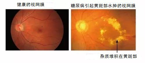 糖尿病引發(fā)的眼底病變