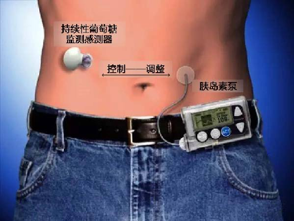 胰島素泵（insulin pump）示意圖